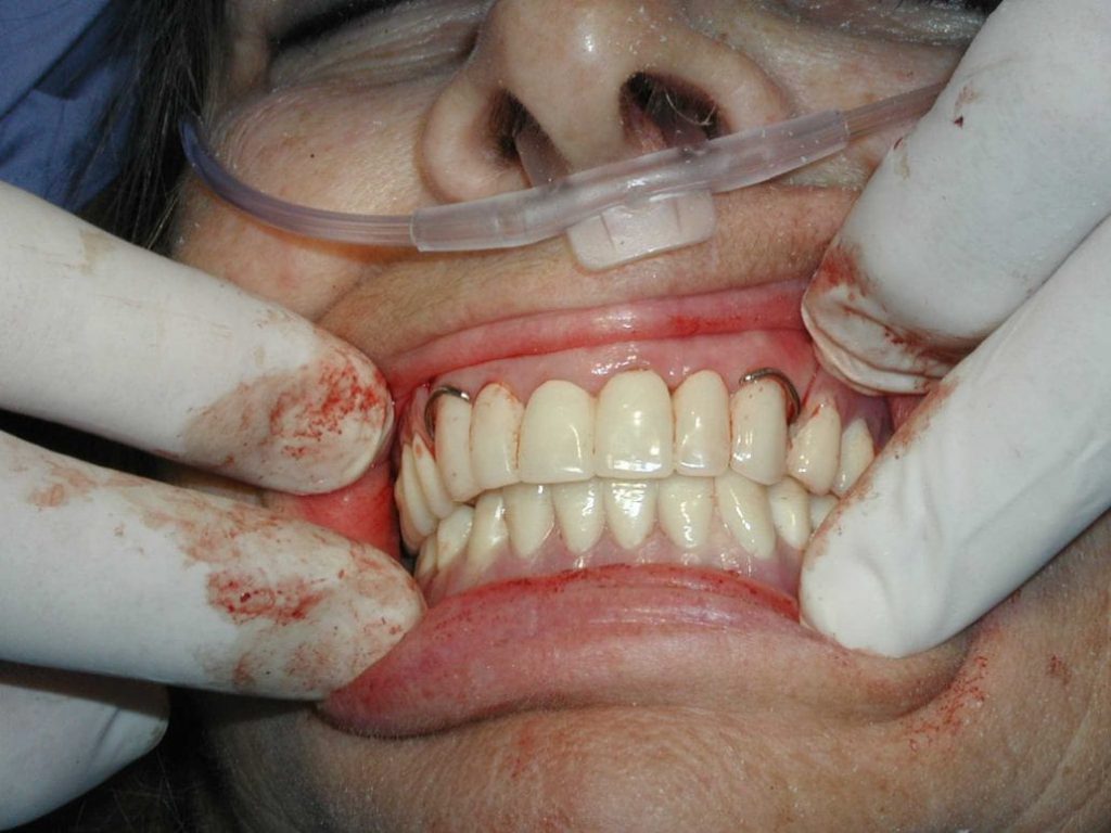 گذاشتن دندان مصنوعی